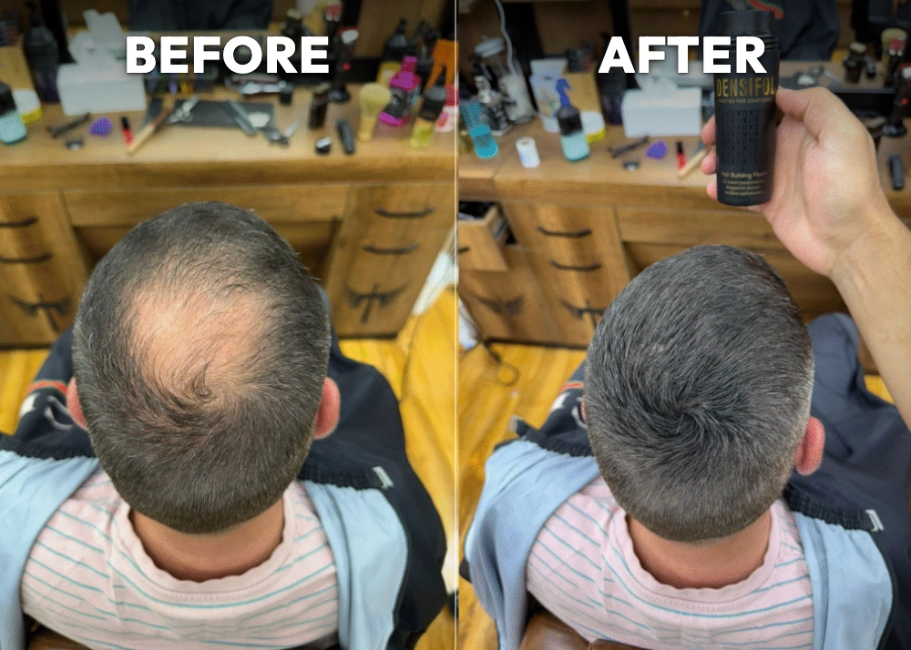 Real customer crown before and after Densifol