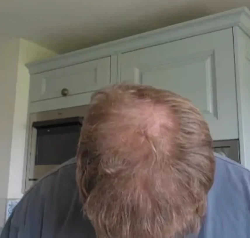 Shaun's crown without Densifol